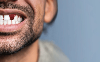 7 Reasons to Replace Missing Teeth